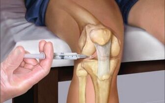 intraartikulárna injekcia do kĺbu na artrózu