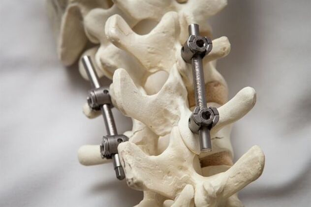 fixácia chrbtovej osteochondrózy krku