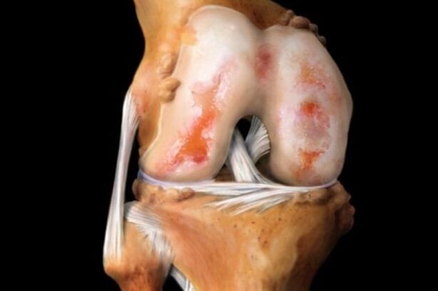 poškodenie chrupavky pri artróze kolena