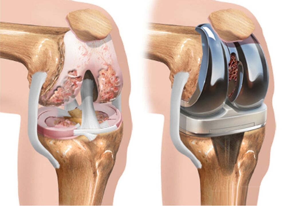 pred a po artróze kolenného kĺbu pri artróze