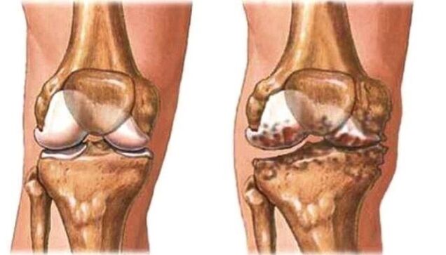 zdravé koleno a kolenná artróza