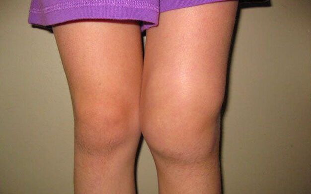 opuchnutý kolenný kĺb v dôsledku artrózy