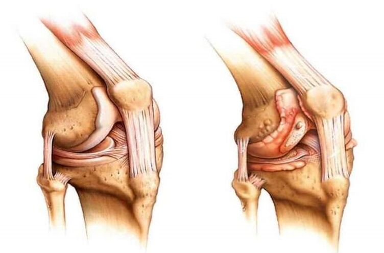 zdravé koleno a artróza kolenného kĺbu