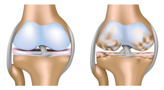 zdravú chrupavku a poškodenie kolenného kĺbu s artrózou
