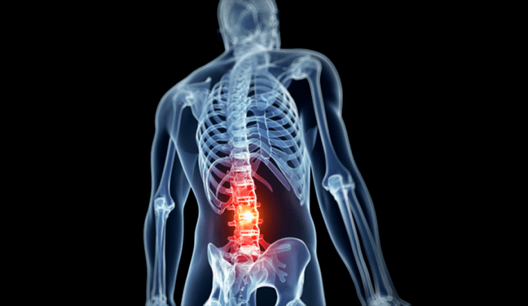 lézia bedrovej chrbtice pri osteochondróze