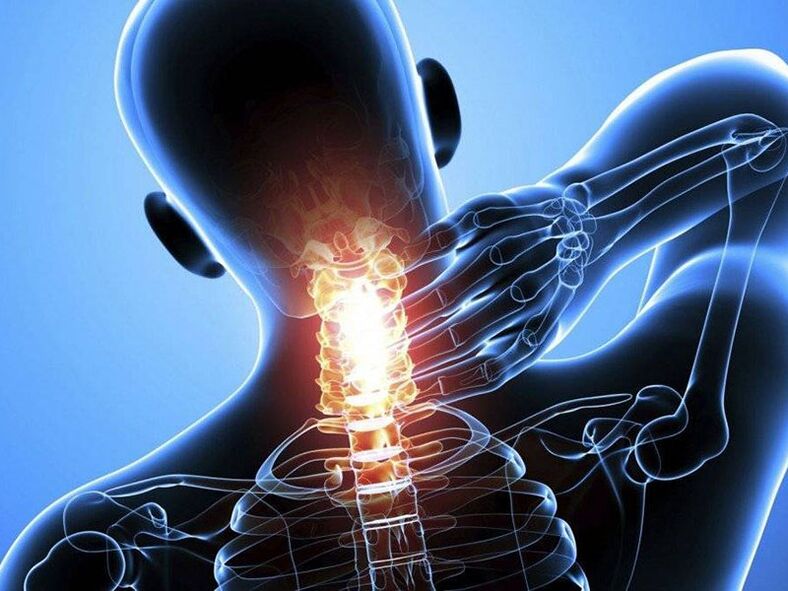 Osteochondróza krčnej chrbtice je sprevádzaná bolesťou v krku