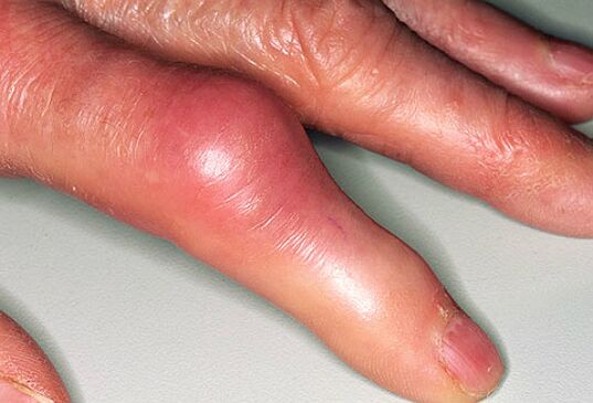 Dna je sprevádzaná ostrou bolesťou v prstoch a opuchom kĺbov. 