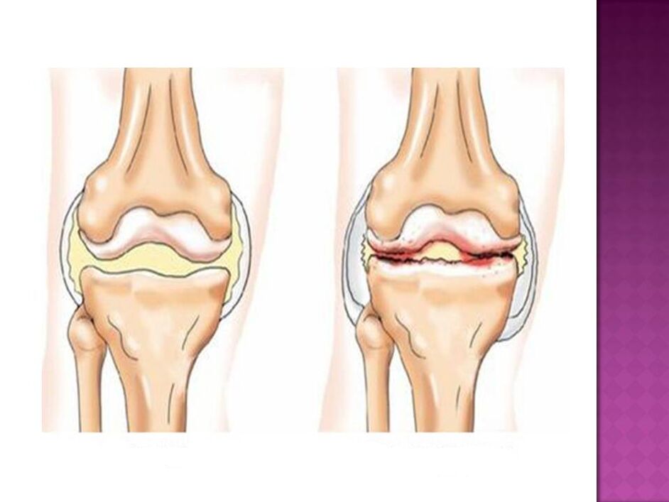 Kĺb je normálny (vľavo) a postihnutý osteoartrózou (vpravo)