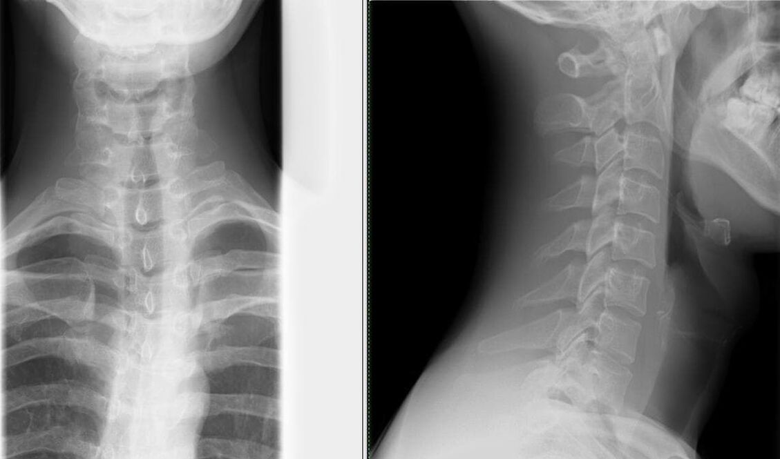 Röntgenové vyšetrenie chrbtice je jednoduchá a účinná metóda na diagnostiku osteochondrózy