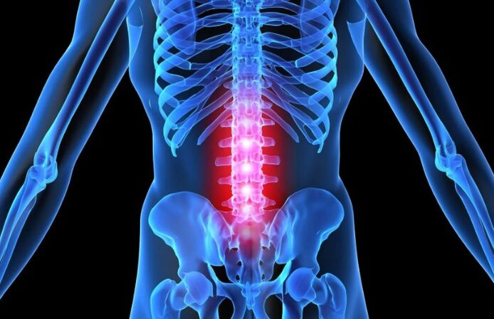 Osteochondróza bedrovej oblasti