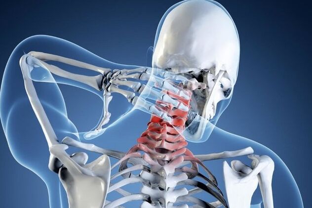 osteochondróza krčnej chrbtice